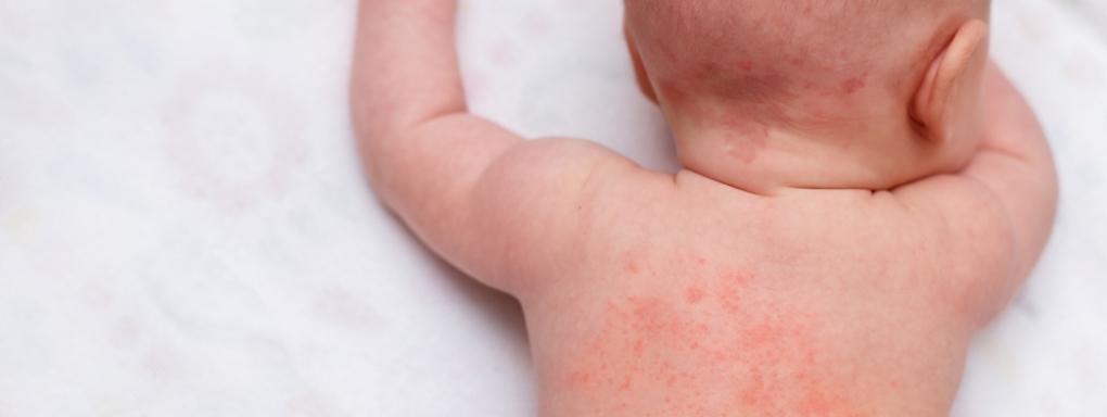 Atopowe zapalenie skóry u niemowląt. Jak leczyć AZS?