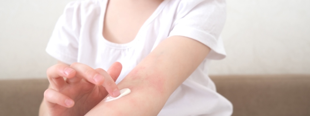 Zrozumienie i zarządzanie atopowym zapaleniem skóry u dziecka: kluczowe wskazówki i strategie kompleksowej pielęgnacji