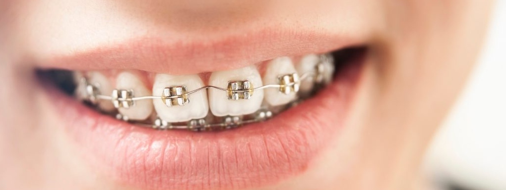 Jak dbać o higienę jamy ustnej po założeniu aparatu ortodontycznego?